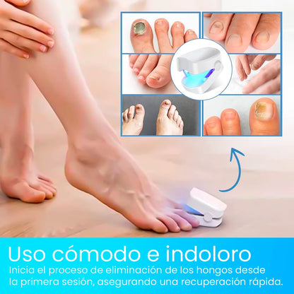 ¡Deshazte de los hongos y uñas débiles en solo 6 ciclos! Tratamiento láser rápido y seguro - CuraLáser