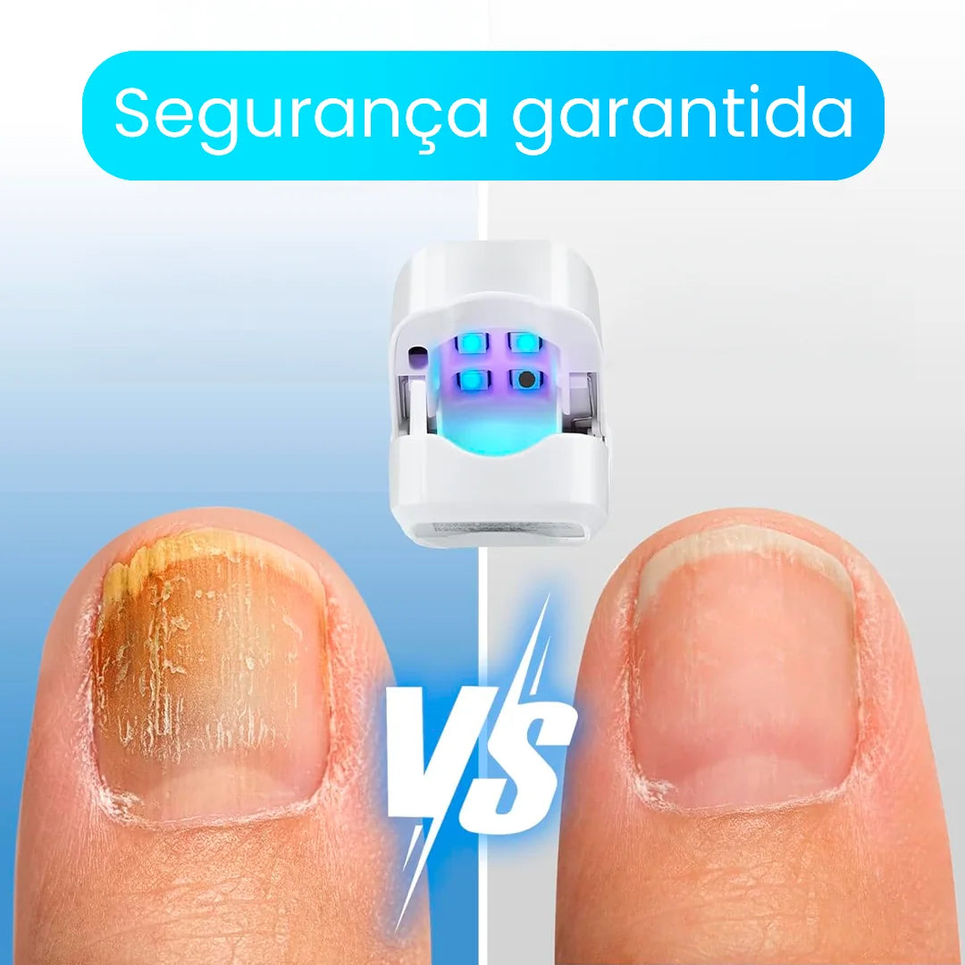 ¡Deshazte de los hongos y uñas débiles en solo 6 ciclos! Tratamiento láser rápido y seguro - CuraLáser