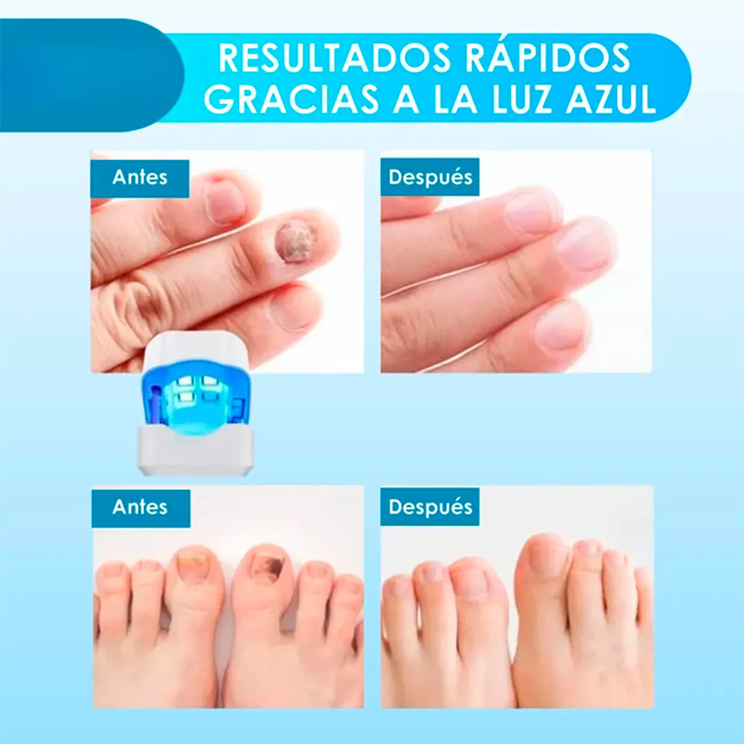 ¡Deshazte de los hongos y uñas débiles en solo 6 ciclos! Tratamiento láser rápido y seguro - CuraLáser