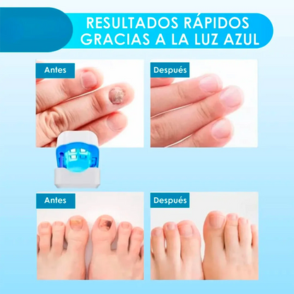 ¡Deshazte de los hongos y uñas débiles en solo 6 ciclos! Tratamiento láser rápido y seguro - CuraLáser